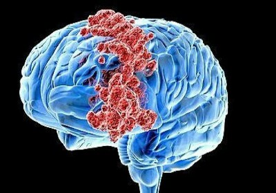 Wanita Idap Tumor Otak